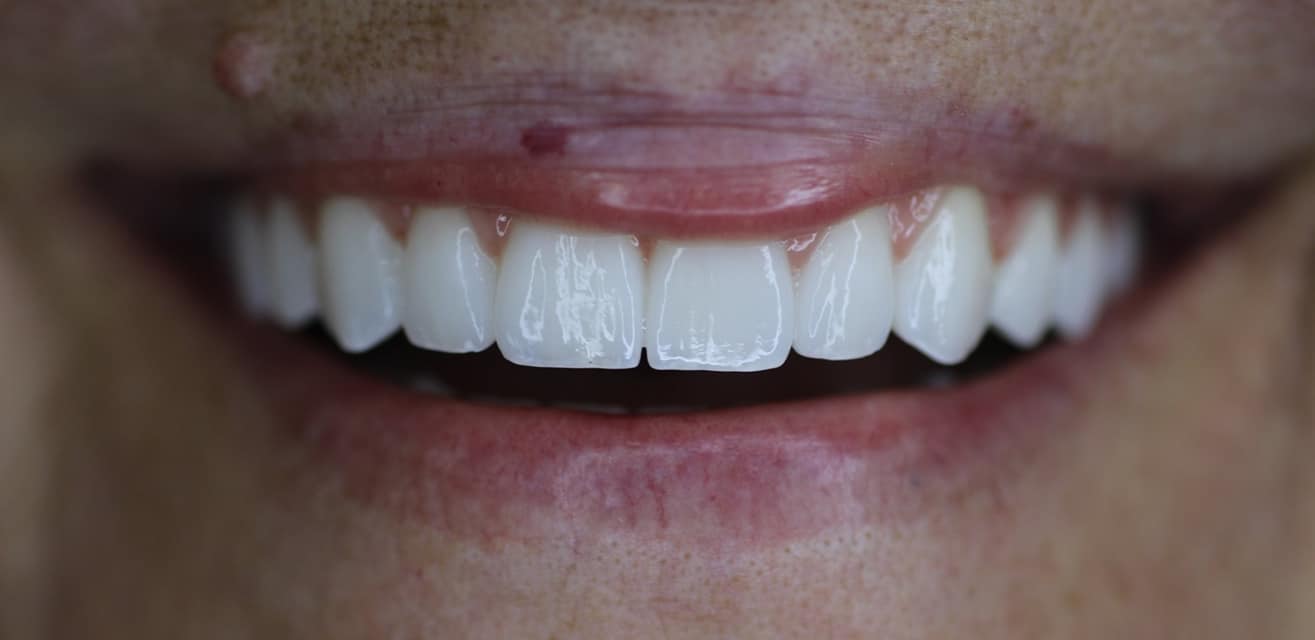 implant dentar dinte ceramica