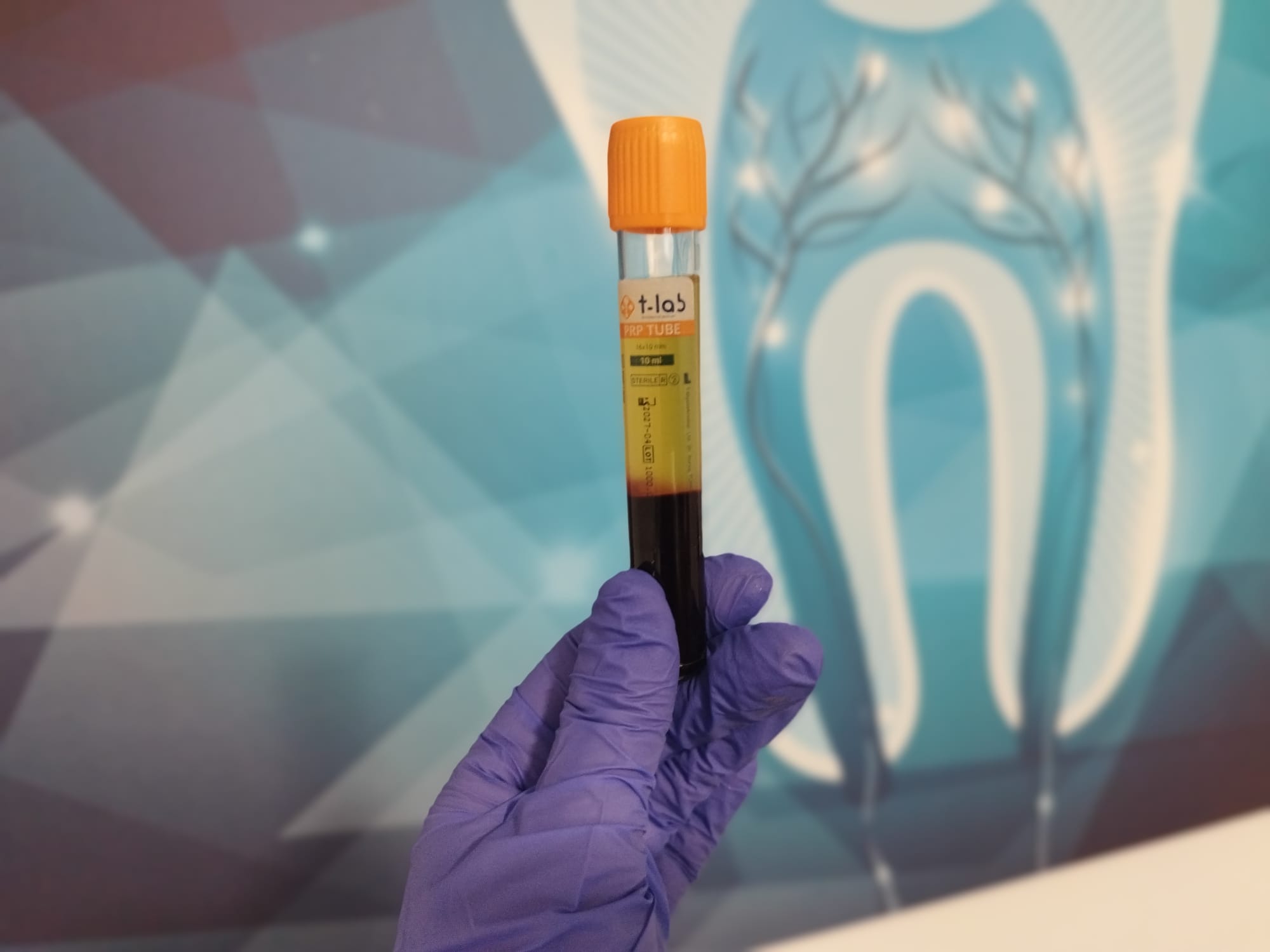 tratament plasma parodontoza